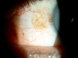 白目のシミ取りレーザー治療症例写真