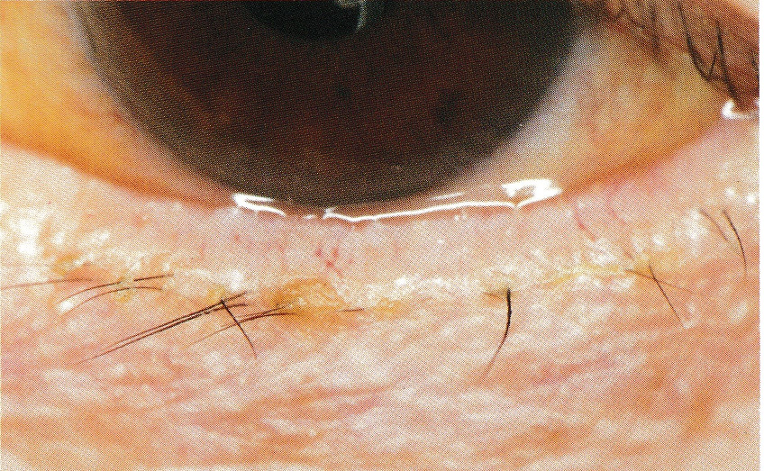 眼瞼縁炎 よくある目の病気 10 京橋クリニック眼科 大阪市都島区京橋駅前の眼科専門のクリニック
