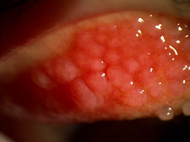 春季カタル よくある目の病気 31 京橋クリニック眼科 大阪市都島区京橋駅前の眼科専門のクリニック