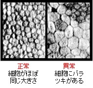 水疱性角膜症と角膜内皮障害 よくある目の病気 49 京橋クリニック眼科 大阪市都島区京橋駅前の眼科専門のクリニック