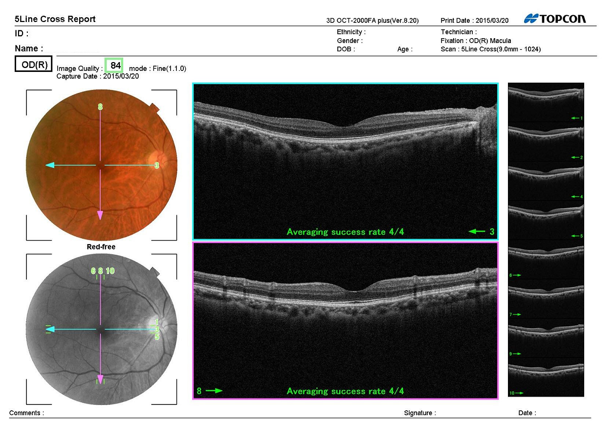 網膜上膜 よくある目の病気 73 京橋クリニック眼科 大阪市都島区京橋駅前の眼科専門のクリニック