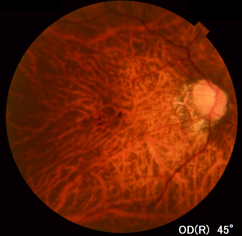 近視性網脈絡膜萎縮 よくある目の病気 79 京橋クリニック眼科 大阪市都島区京橋駅前の眼科専門のクリニック